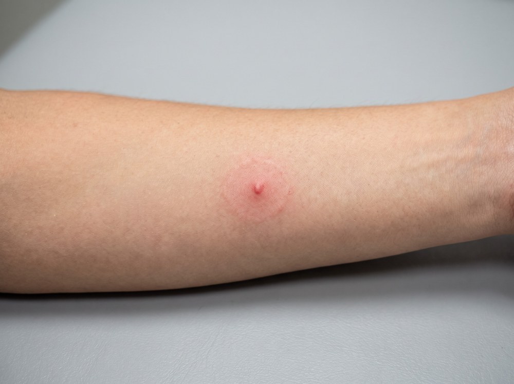 Close-up photo of a small mild red bite mark on skin with two faint puncture points and no blistering or discoloration